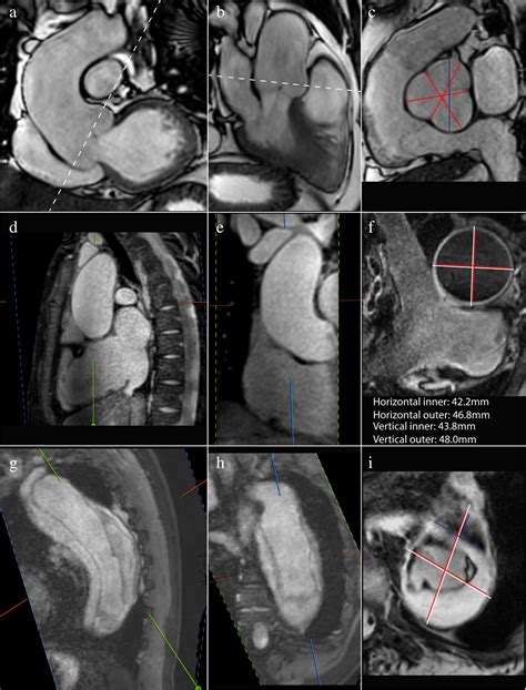 Measuriing Aorta wall thickness 